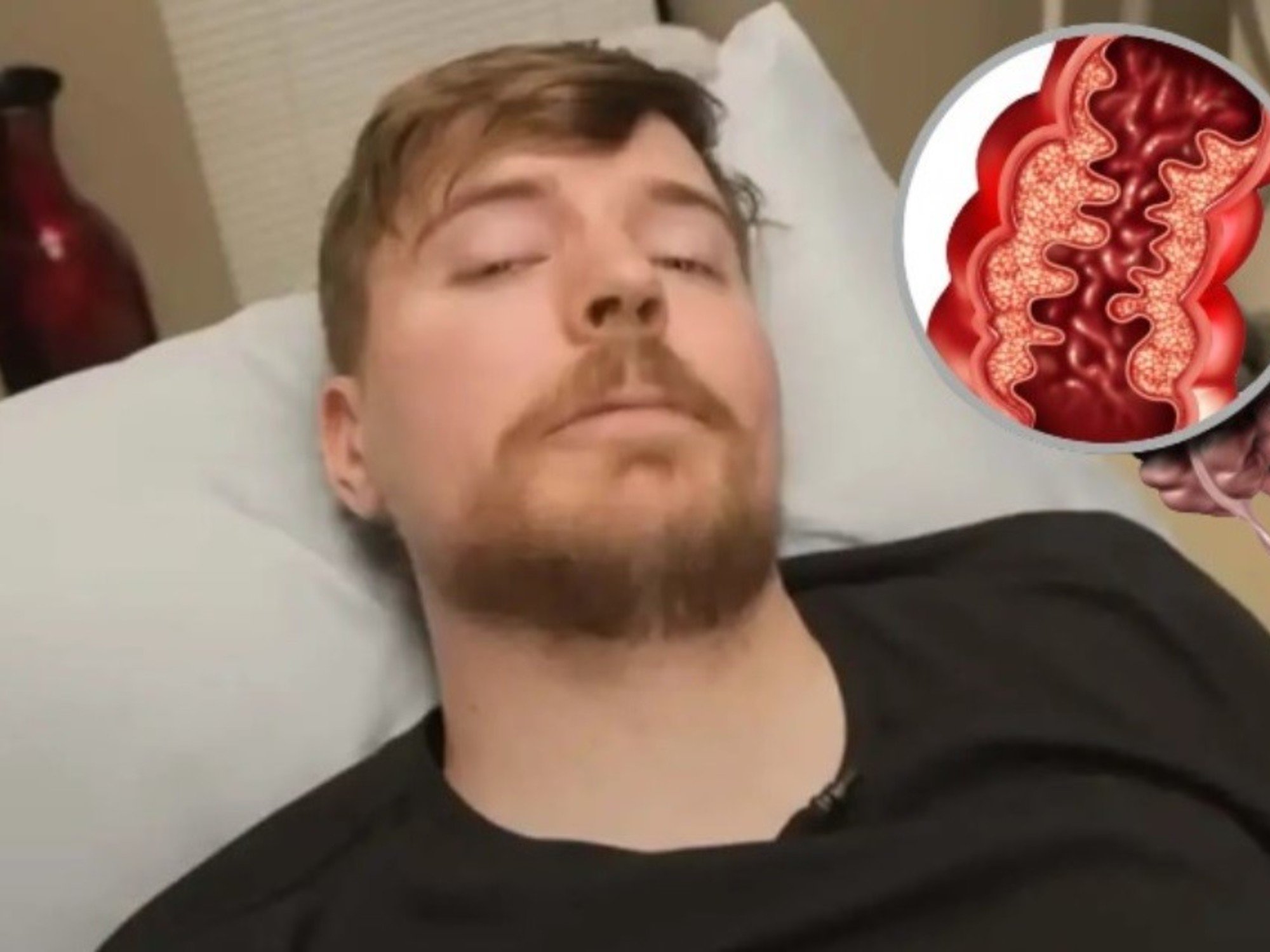 "Duele como el demonio": Qué es la enfermedad de Crohn, la afección inflamatoria intestinal que sufre MrBeast desde los 15 años