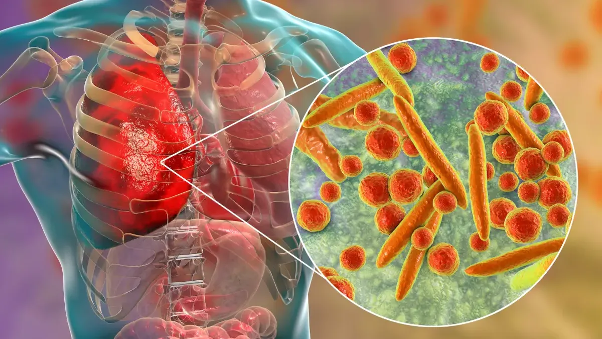 Salud: científicos revelaron el impacto de la higiene bucal en la prevención de la neumonía