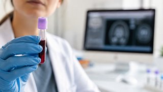 Alzheimer: un test de sangre permite detectar señales antes que los métodos tradicionales