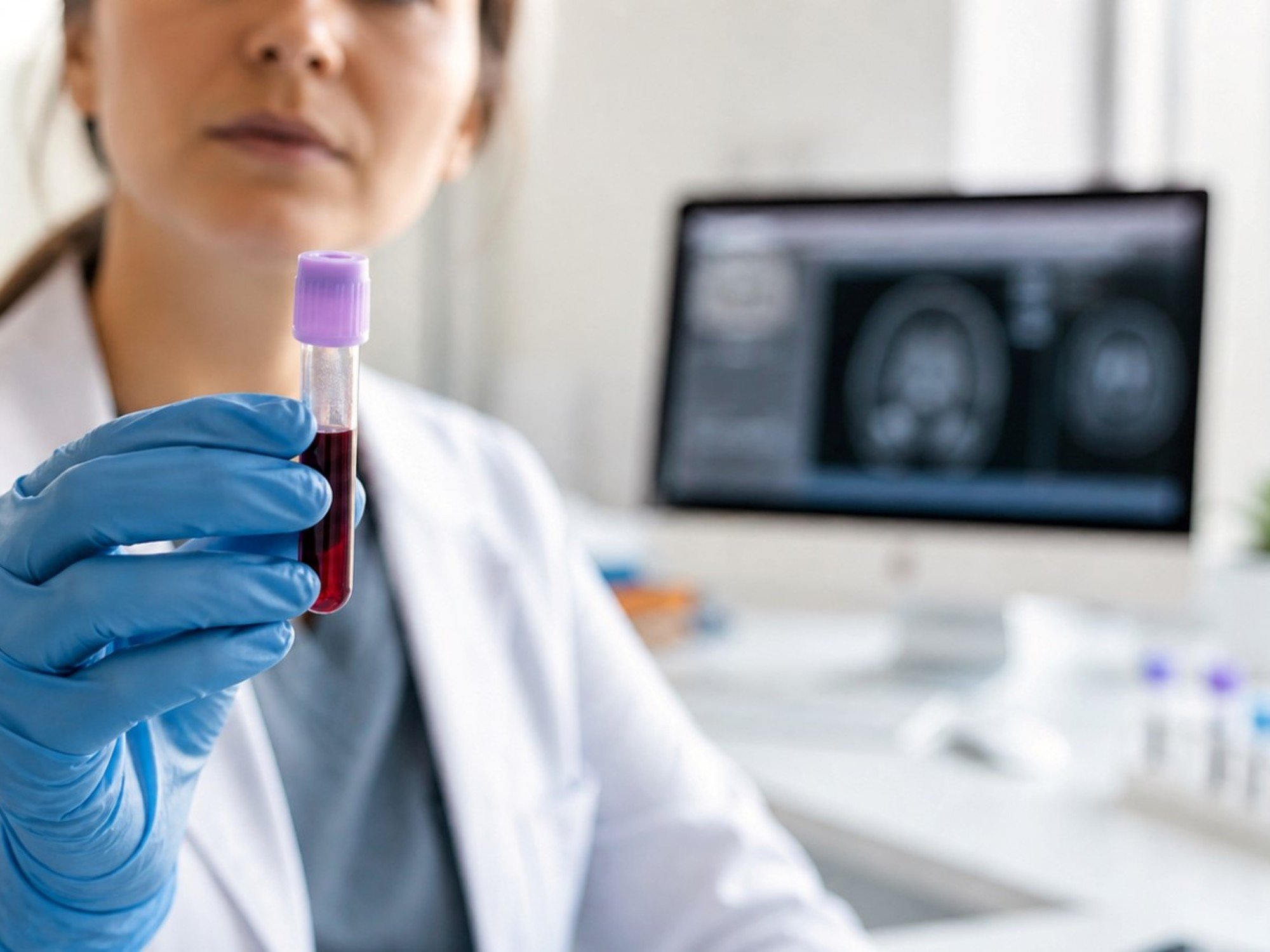 Alzheimer: un test de sangre permite detectar señales antes que los métodos tradicionales